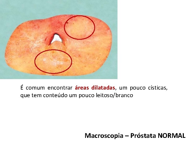 É comum encontrar áreas dilatadas, um pouco císticas, que tem conteúdo um pouco leitoso/branco