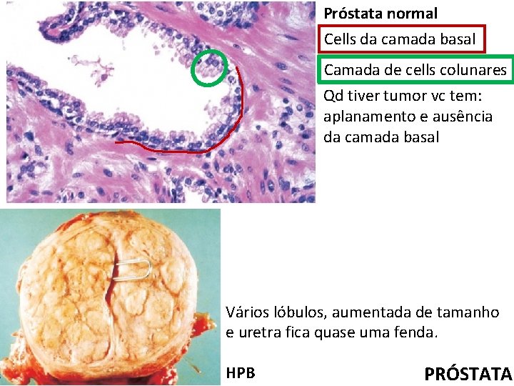 Próstata normal Cells da camada basal Camada de cells colunares Qd tiver tumor vc