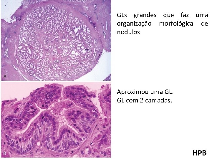 GLs grandes que faz uma organização morfológica de nódulos Aproximou uma GL. GL com