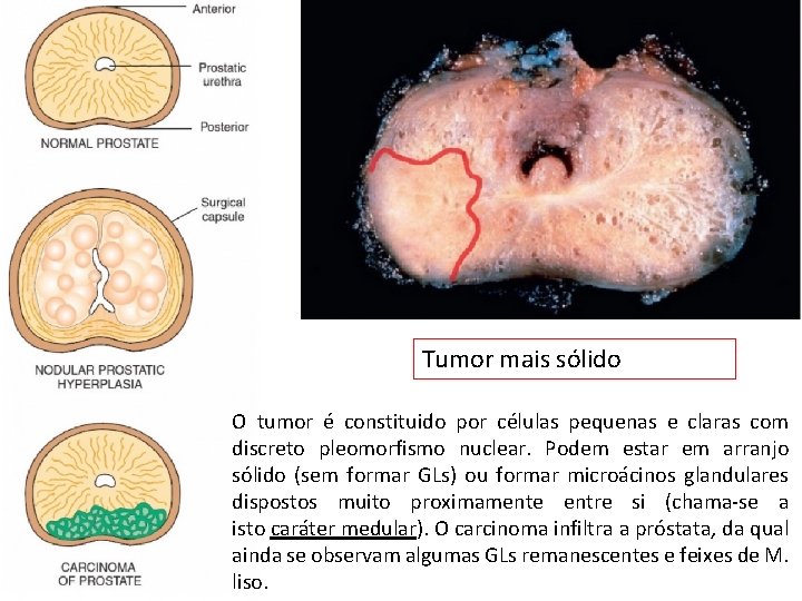 Tumor mais sólido O tumor é constituido por células pequenas e claras com discreto