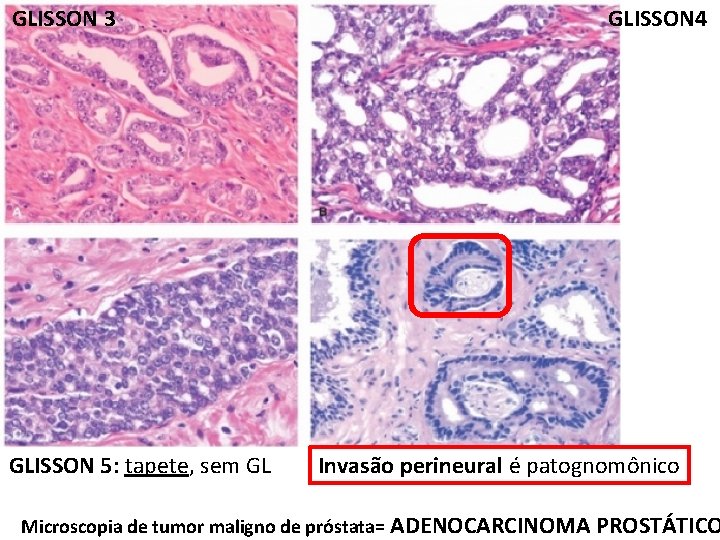 GLISSON 3 GLISSON 5: tapete, sem GL GLISSON 4 Invasão perineural é patognomônico Microscopia