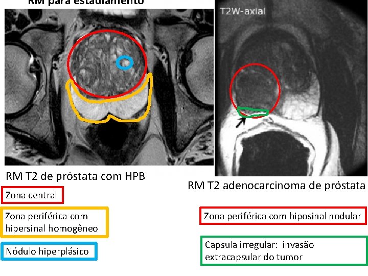 RM para estadiamento RM T 2 de próstata com HPB Zona central Zona periférica