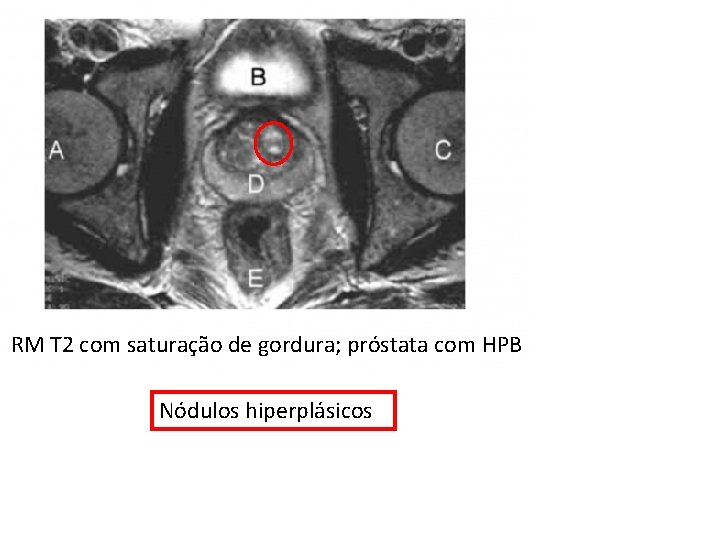 RM T 2 com saturação de gordura; próstata com HPB Nódulos hiperplásicos 