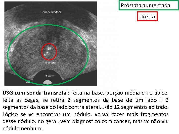 Próstata aumentada Uretra USG com sonda transretal: feita na base, porção média e no