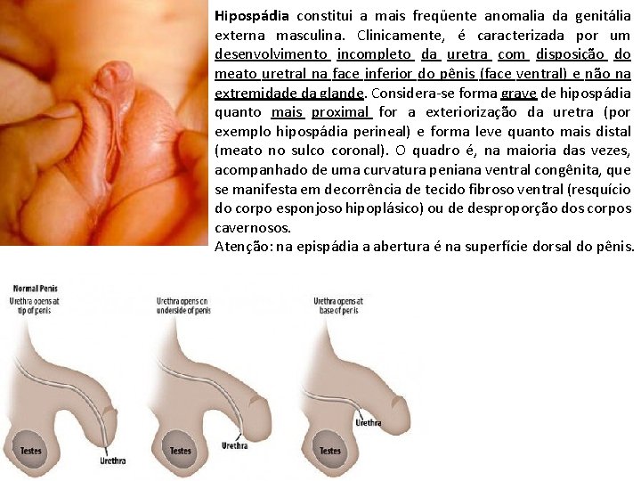 Hipospádia constitui a mais freqüente anomalia da genitália externa masculina. Clinicamente, é caracterizada por