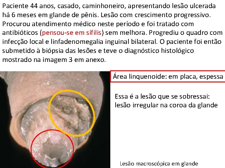 Paciente 44 anos, casado, caminhoneiro, apresentando lesão ulcerada há 6 meses em glande de