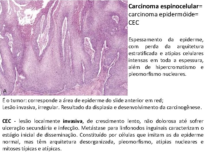 Carcinoma espinocelular= carcinoma epidermóide= CEC Espessamento da epiderme, com perda da arquitetura estratificada e