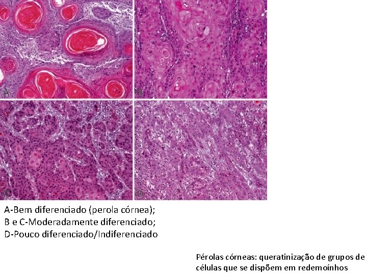 A-Bem diferenciado (perola córnea); B e C-Moderadamente diferenciado; D-Pouco diferenciado/Indiferenciado Pérolas córneas: queratinização de