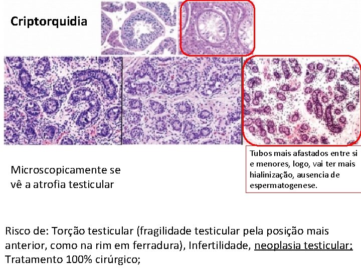 Criptorquidia Microscopicamente se vê a atrofia testicular Tubos mais afastados entre si e menores,