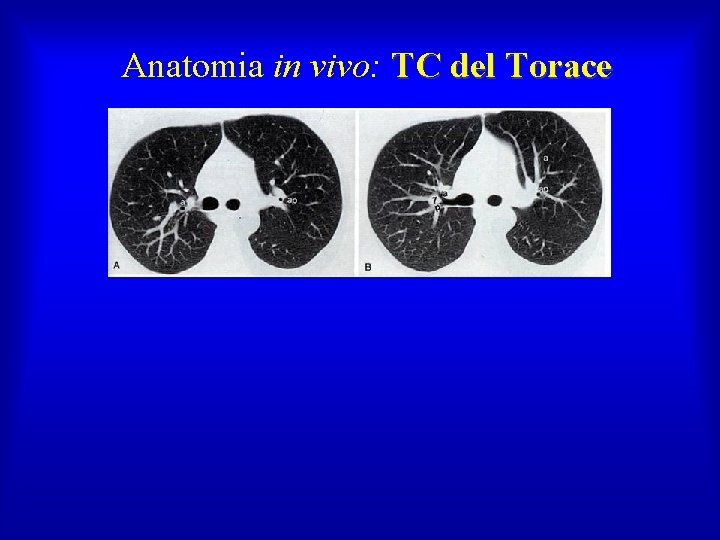 Anatomia in vivo: TC del Torace 