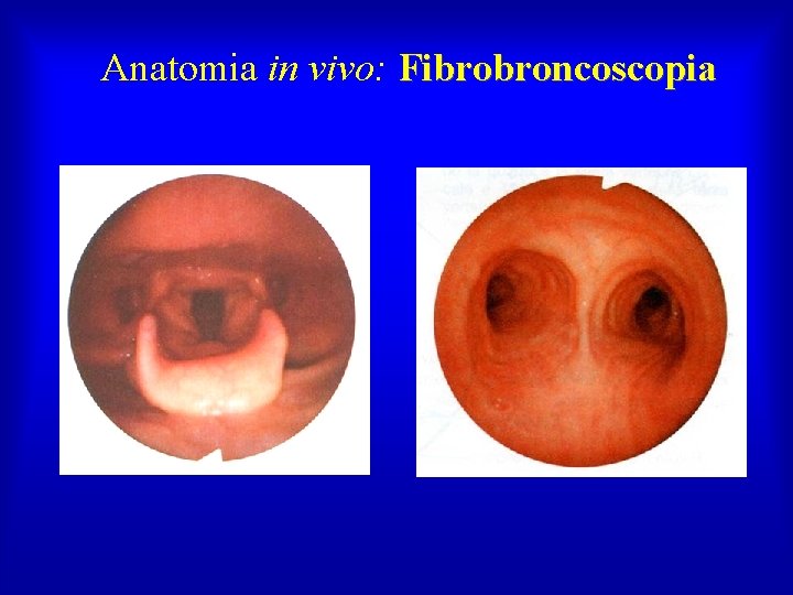 Anatomia in vivo: Fibrobroncoscopia 