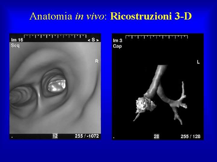 Anatomia in vivo: Ricostruzioni 3 -D 