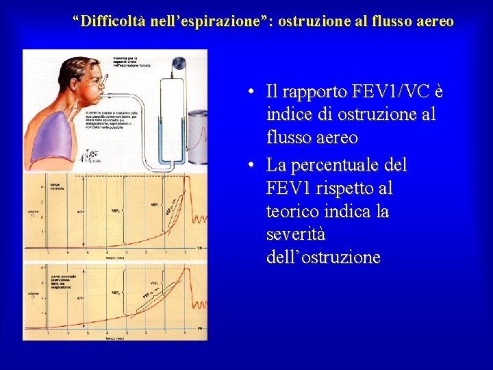 “Difficoltà nell’espirazione”: ostruzione al flusso aereo • Il rapporto FEV 1/VC è indice di