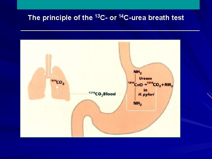 The principle of the 13 C- or 14 C-urea breath test Reproduced with permission