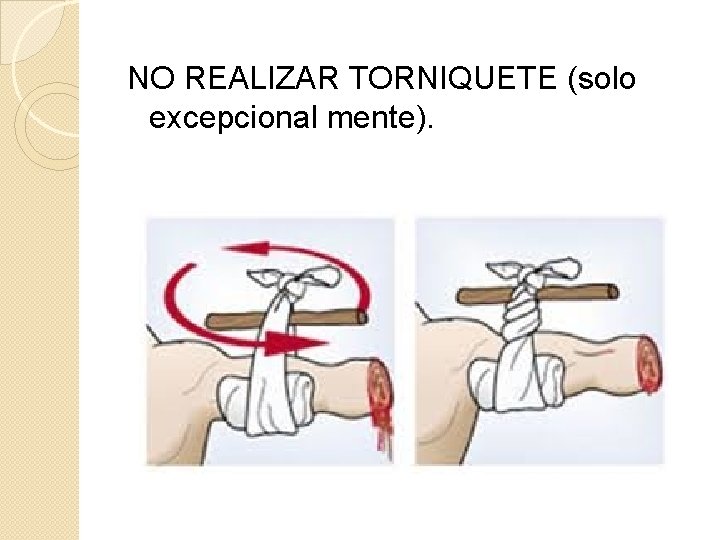 NO REALIZAR TORNIQUETE (solo excepcional mente). 