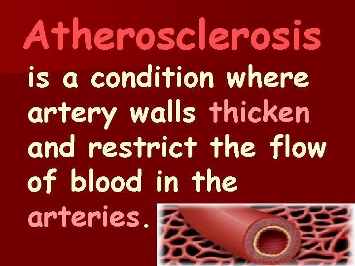 Atherosclerosis is a condition where artery walls thicken and restrict the flow of blood