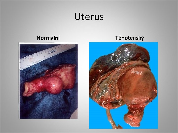 Uterus Normální Těhotenský 