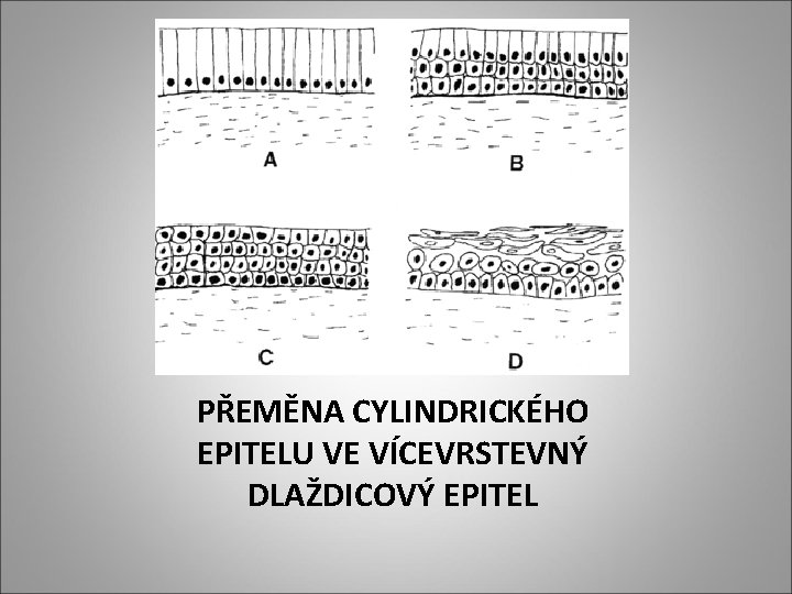 PŘEMĚNA CYLINDRICKÉHO EPITELU VE VÍCEVRSTEVNÝ DLAŽDICOVÝ EPITEL 