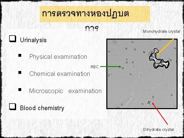 การตรวจทางหองปฏบต การ q Urinalysis § Physical examination § Chemical examination Monohydrate crystal RBC §
