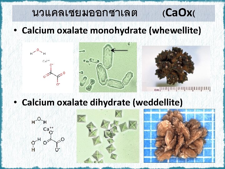 นวแคลเซยมออกซาเลต (Ca. Ox( • Calcium oxalate monohydrate (whewellite) • Calcium oxalate dihydrate (weddellite) 