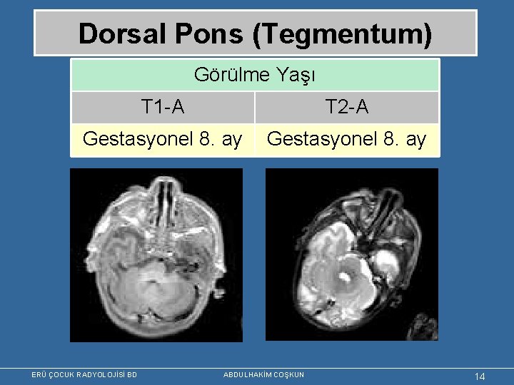 Dorsal Pons (Tegmentum) Görülme Yaşı T 1 -A T 2 -A Gestasyonel 8. ay