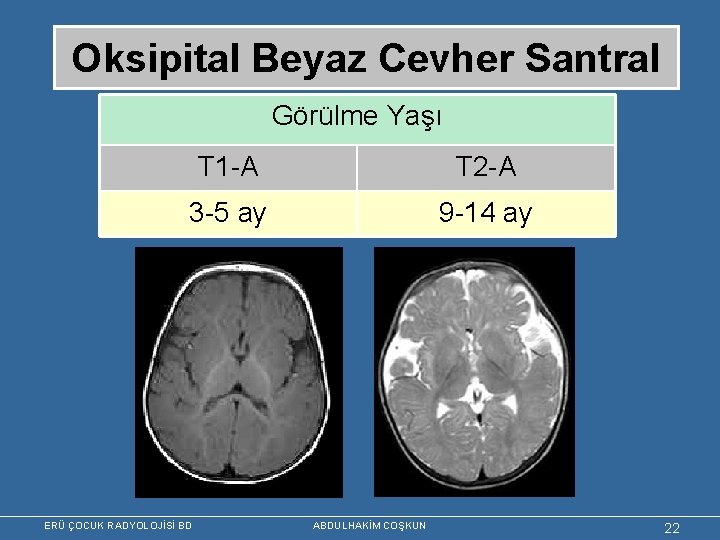 Oksipital Beyaz Cevher Santral Görülme Yaşı T 1 -A T 2 -A 3 -5