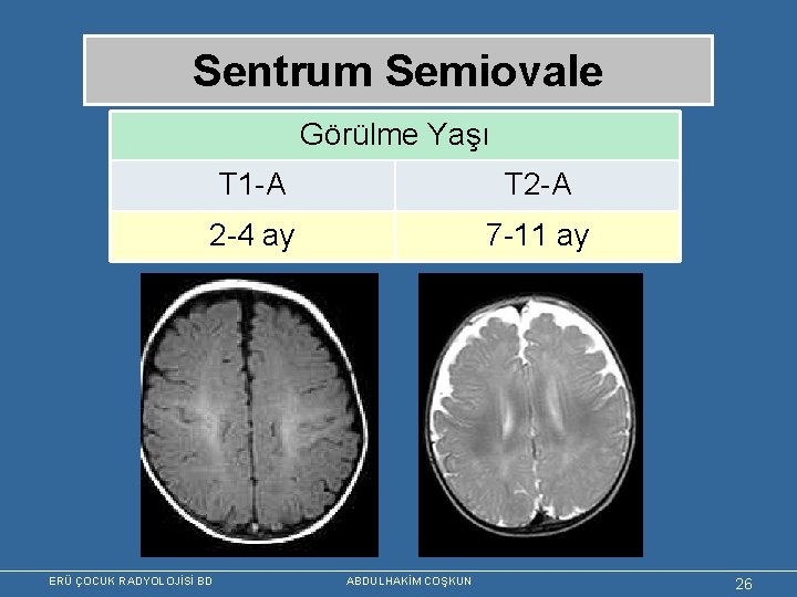 Sentrum Semiovale Görülme Yaşı T 1 -A T 2 -A 2 -4 ay 7