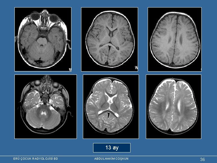 13 ay ERÜ ÇOCUK RADYOLOJİSİ BD ABDULHAKİM COŞKUN 36 