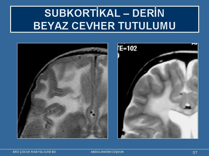 SUBKORTİKAL – DERİN BEYAZ CEVHER TUTULUMU ERÜ ÇOCUK RADYOLOJİSİ BD ABDULHAKİM COŞKUN 57 