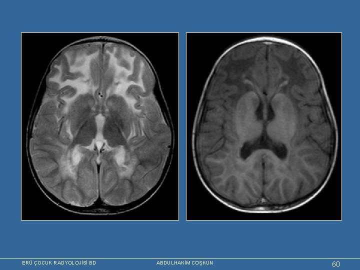 ERÜ ÇOCUK RADYOLOJİSİ BD ABDULHAKİM COŞKUN 60 