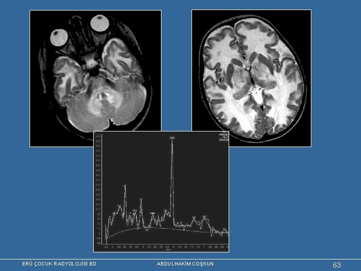 ERÜ ÇOCUK RADYOLOJİSİ BD ABDULHAKİM COŞKUN 63 