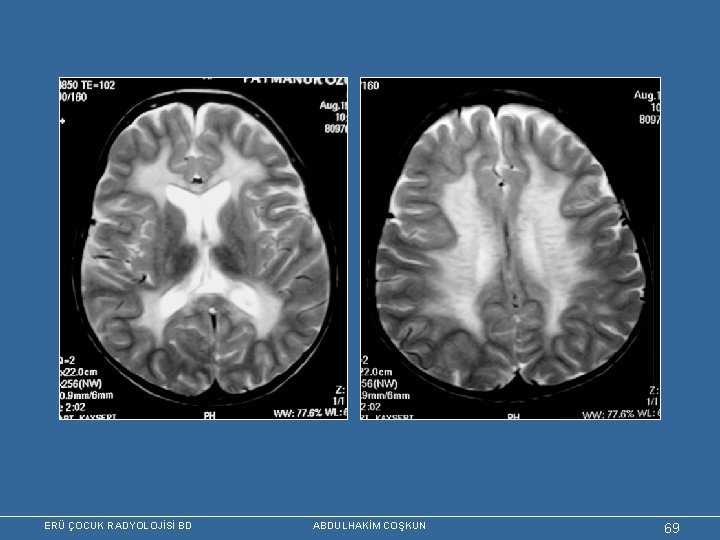 ERÜ ÇOCUK RADYOLOJİSİ BD ABDULHAKİM COŞKUN 69 