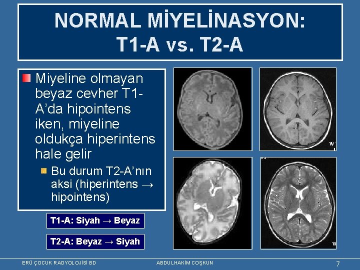 NORMAL MİYELİNASYON: T 1 -A vs. T 2 -A Miyeline olmayan beyaz cevher T