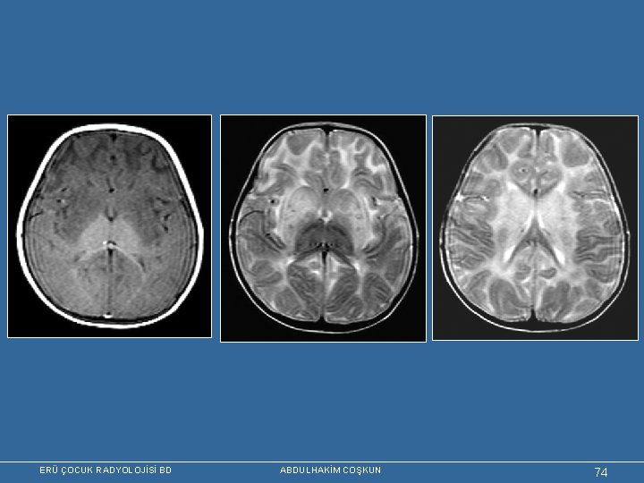 ERÜ ÇOCUK RADYOLOJİSİ BD ABDULHAKİM COŞKUN 74 