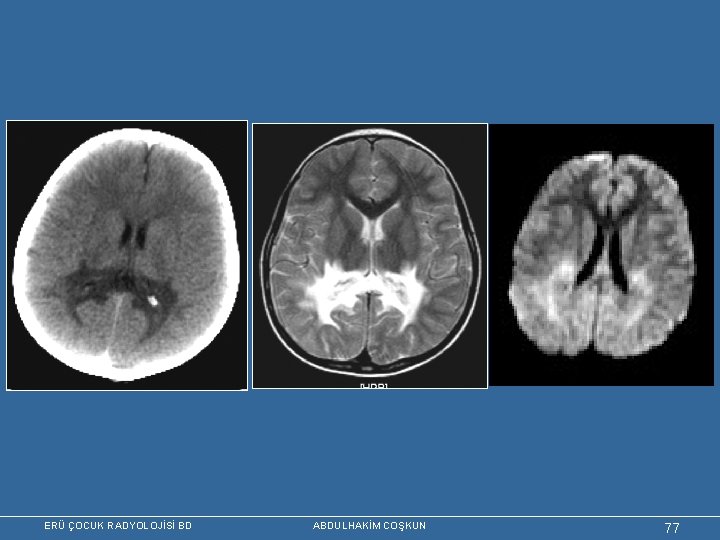 ERÜ ÇOCUK RADYOLOJİSİ BD ABDULHAKİM COŞKUN 77 