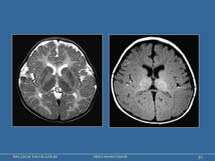 ERÜ ÇOCUK RADYOLOJİSİ BD ABDULHAKİM COŞKUN 81 