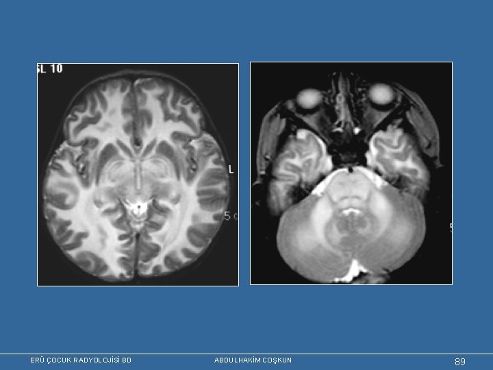 ERÜ ÇOCUK RADYOLOJİSİ BD ABDULHAKİM COŞKUN 89 
