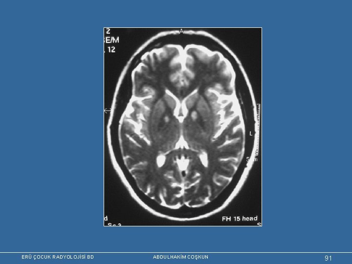 ERÜ ÇOCUK RADYOLOJİSİ BD ABDULHAKİM COŞKUN 91 