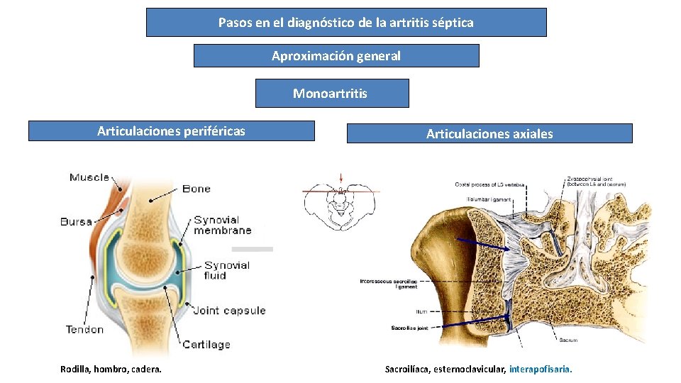 Pasos en el diagnóstico de la artritis séptica Aproximación general Monoartritis Articulaciones periféricas Rodilla,