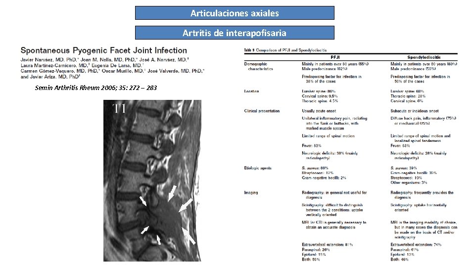 Articulaciones axiales Artritis de interapofisaria Semin Arthritis Rheum 2006; 35: 272 – 283 