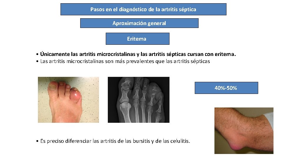 Pasos en el diagnóstico de la artritis séptica Aproximación general Eritema • Únicamente las