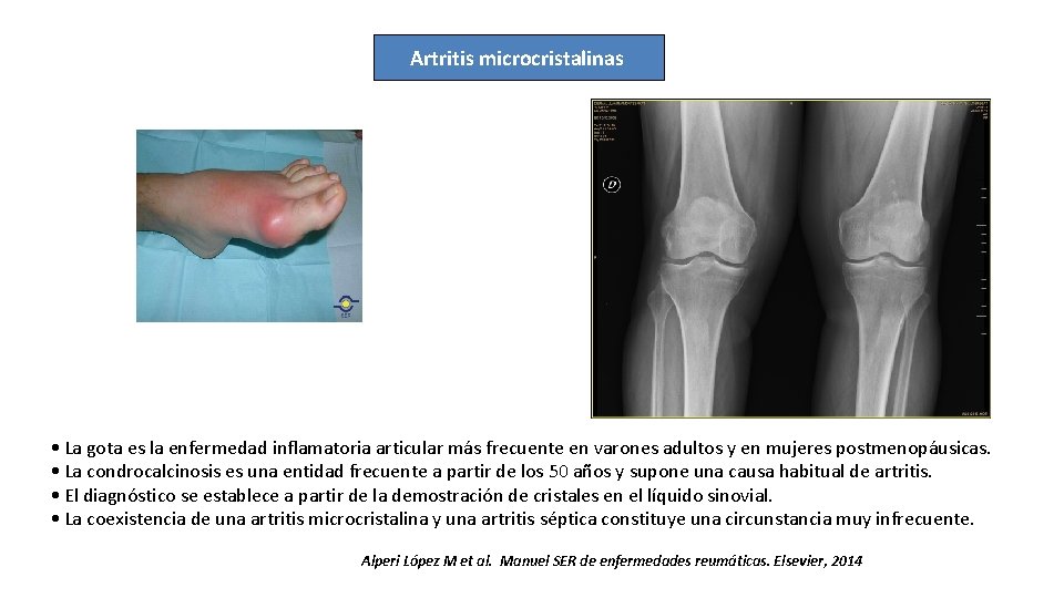 Artritis microcristalinas • La gota es la enfermedad inflamatoria articular más frecuente en varones