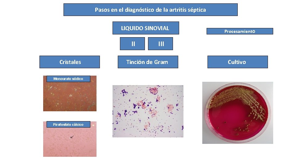 Pasos en el diagnóstico de la artritis séptica LIQUIDO SINOVIAL II Cristales Monourato sódico