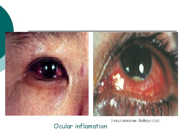 Ocular inflamation 