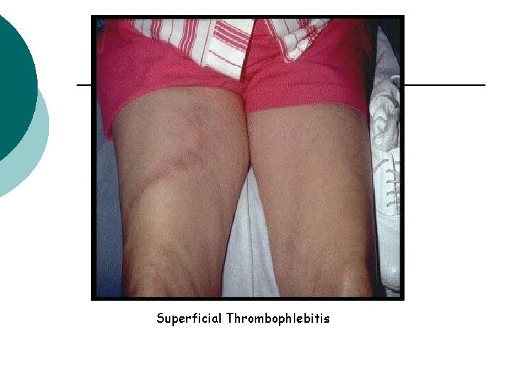 Superficial Thrombophlebitis 