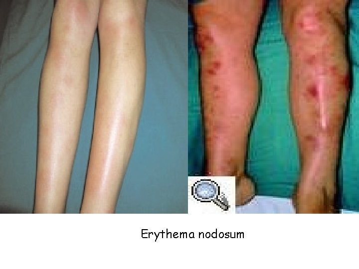 Erythema nodosum 