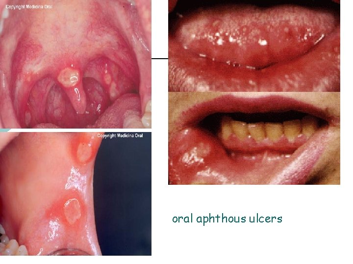oral aphthous ulcers 