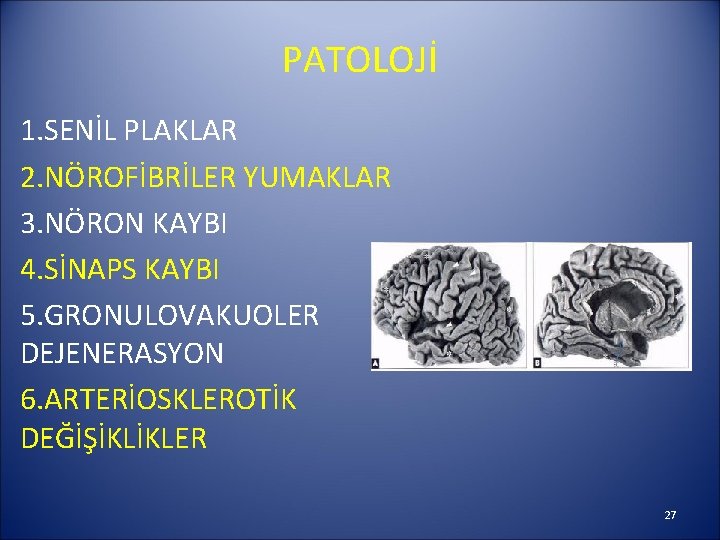 PATOLOJİ 1. SENİL PLAKLAR 2. NÖROFİBRİLER YUMAKLAR 3. NÖRON KAYBI 4. SİNAPS KAYBI 5.