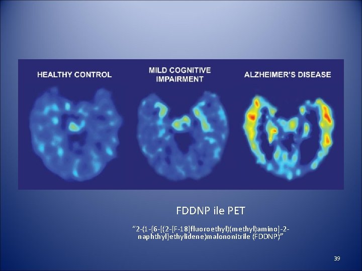 FDDNP ile PET “ 2 -(1 -{6 -[(2 -[F-18]fluoroethyl)(methyl)amino]-2 naphthyl}ethylidene)malononitrile (FDDNP)” 39 