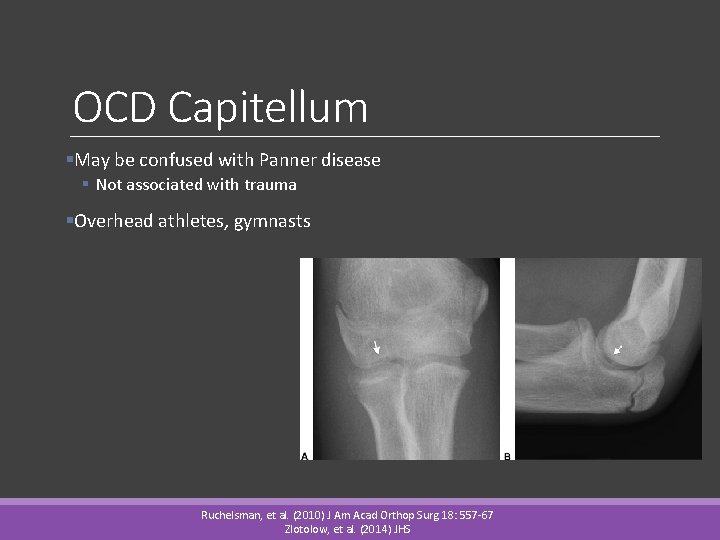 OCD Capitellum §May be confused with Panner disease § Not associated with trauma §Overhead